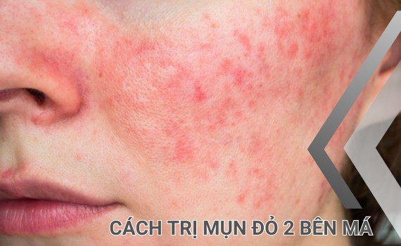 Hình ảnh minh họa về Cách trị mụn đỏ 2 bên má