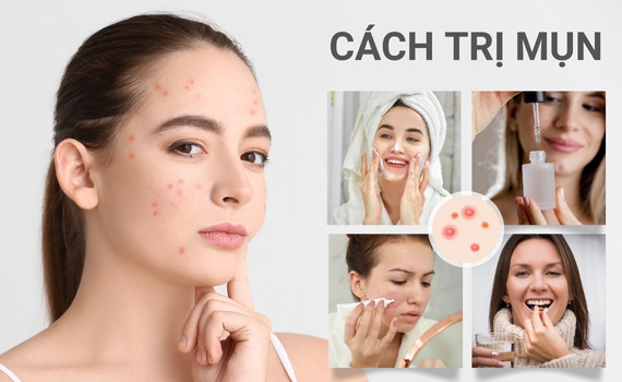 Hình ảnh minh họa về Cách trị mụn