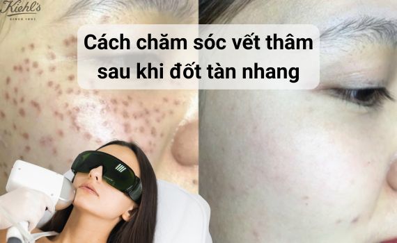 Hình ảnh minh họa về cách chăm sóc vết thâm sau khi đốt tàn nhang