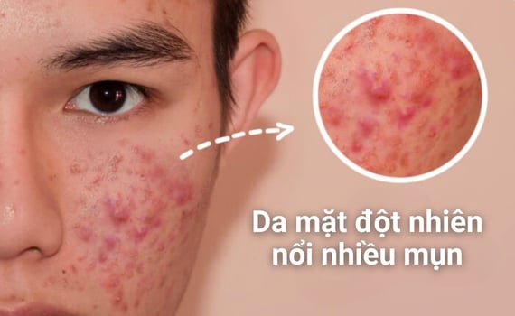 Hình ảnh minh họa về Da mặt đột nhiên nổi nhiều mụn
