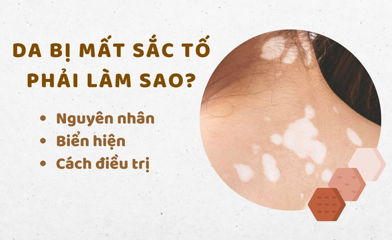 Hình ảnh minh họa về da mất sắc tố