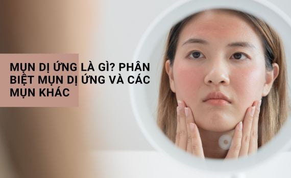 Hình ảnh minh họa về Mụn dị ứng