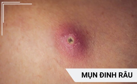 Hình ảnh minh họa về Mụn đinh râu