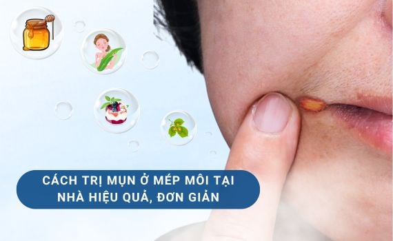 Hình ảnh minh họa về mụn ở mép