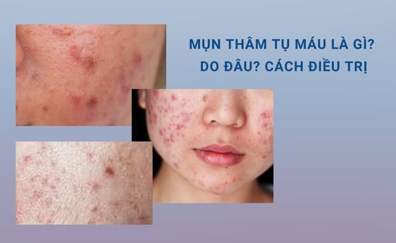 Hình ảnh minh họa về mụn thâm tụ máu