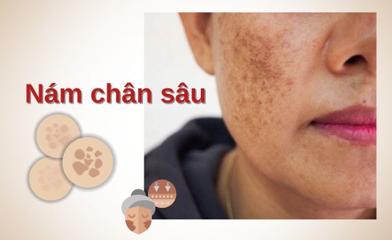 Hình ảnh minh họa về nám chân sâu