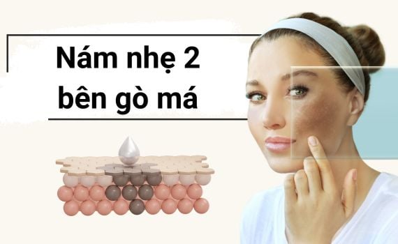 Hình ảnh minh họa về nám nhẹ 2 bên gò má