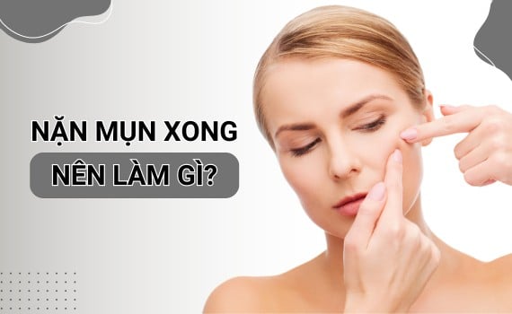 Hình ảnh minh họa về Nặn mụn xong nên làm gì