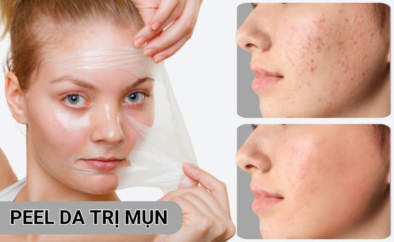 Hình ảnh minh họa về Peel da trị mụn