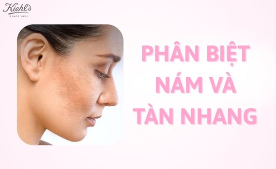 Hình ảnh minh họa về Phân biệt nám và tàn nhang