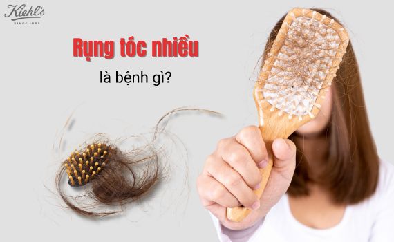 Hình ảnh minh họa về rụng tóc nhiều