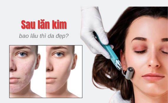 Hình ảnh minh họa về Sau lăn kim bao lâu thì da đẹp