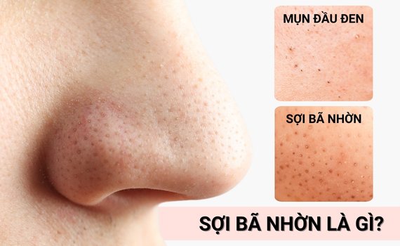 Hình ảnh minh họa về Sợi bã nhờn