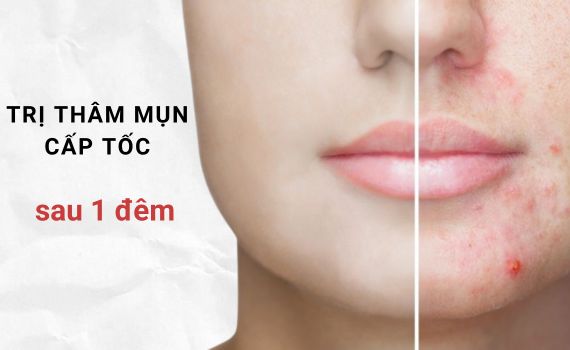 Hình ảnh minh họa về trị thâm mụn cấp tốc sau 1 đêm