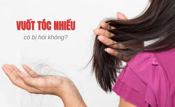 Hình ảnh minh họa về vuốt tóc nhiều có bị hói không