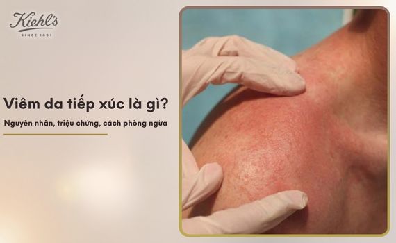 Hình ảnh minh họa về viêm da tiếp xúc